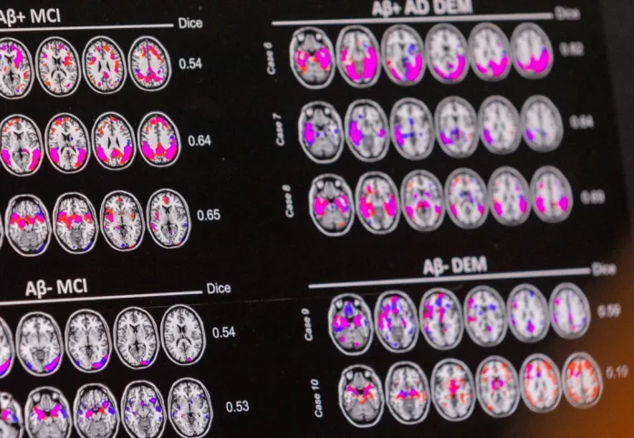 Mungesa e këtij minerali mund të jetë shkaktari i Alzheimer-it
